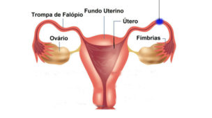 O Que É Gravidez Ectópica