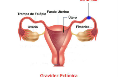 O Que É Gravidez Ectópica, Quais Seus Sintomas, Fatores de Risco e Tratamentos