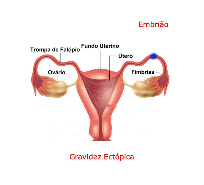 Gravidez Ectopica 1 - O Que É Gravidez Ectópica, Quais Seus Sintomas, Fatores de Risco e Tratamentos