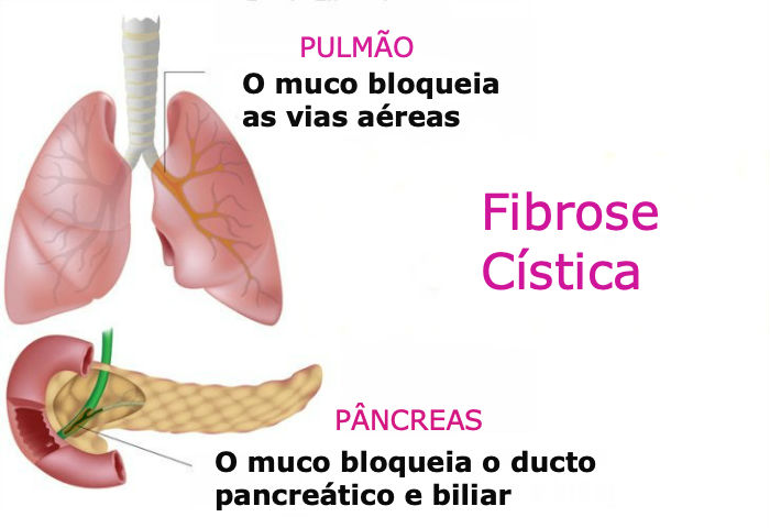 fibrose cistica - O Que É Fibrose Cística? Quais Seus Sintomas e o Tratamento