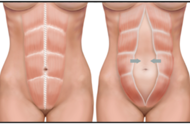 Diástase abdominal: sintomas, tratamento , prevenção e mais