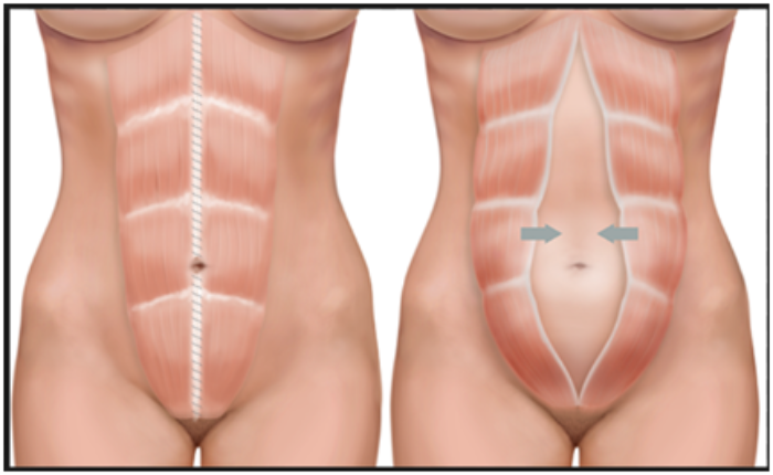 diastase abdominal sintomas tratamento prevencao  - Diástase abdominal: sintomas, tratamento , prevenção e mais